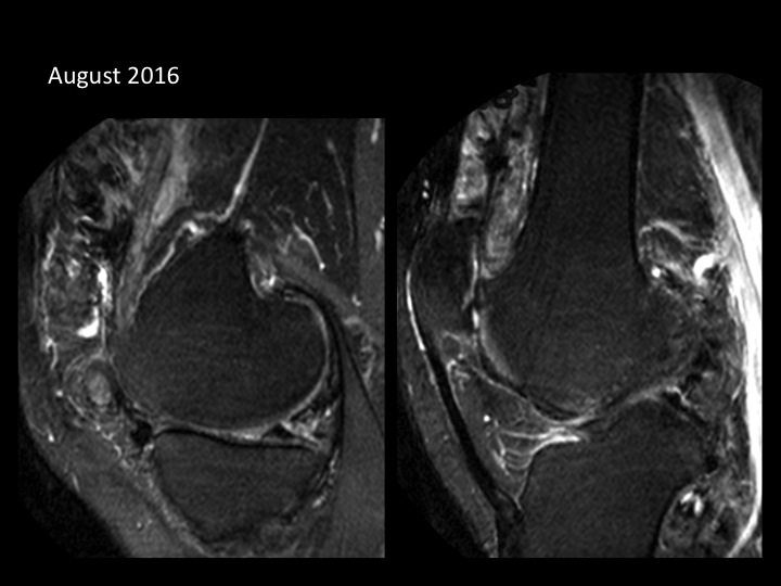 Figure 3 for case pigmented villonodular synovitis ( RID3641 )